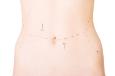 Woman belly marked out for cosmetic surgery. clipart