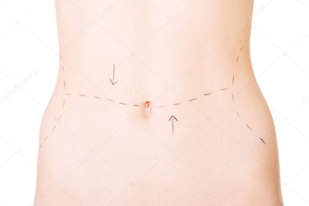 Woman belly marked out for cosmetic surgery.