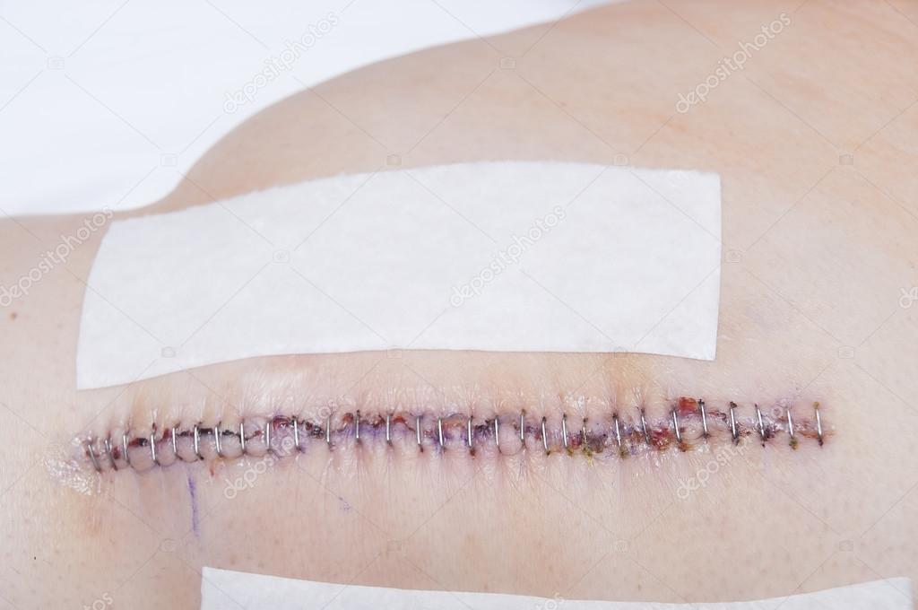 Knee Replacement Staples