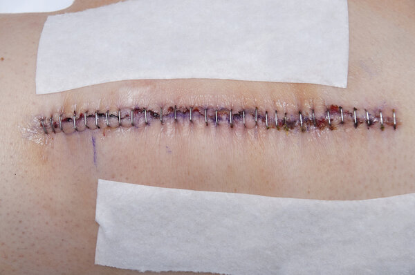 Замена коленного сустава
