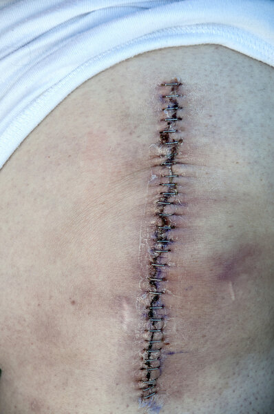 Полная замена колена
