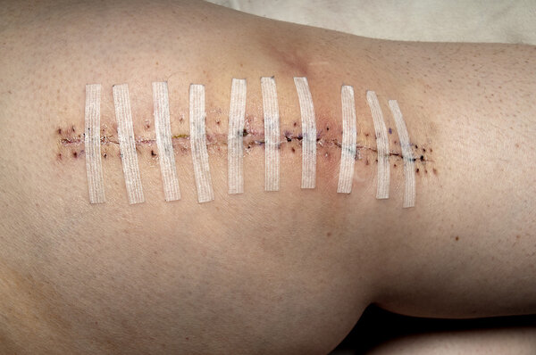 Полная замена колена
