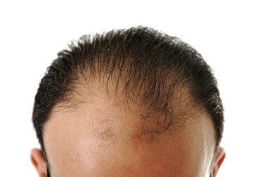 Man loosing hair, baldness clipart