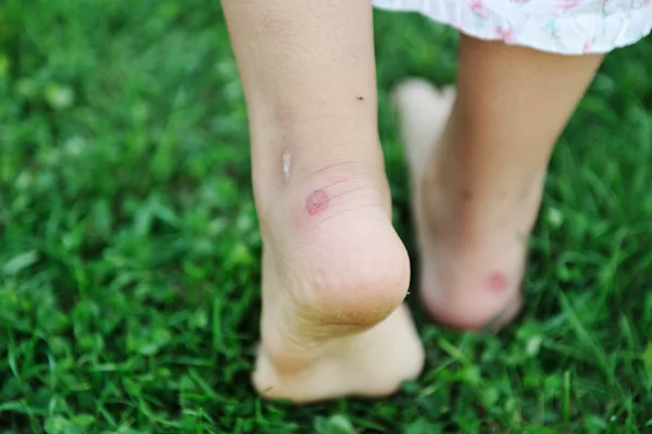 Human walking on grass with callus on feet — Stock Photo, Image