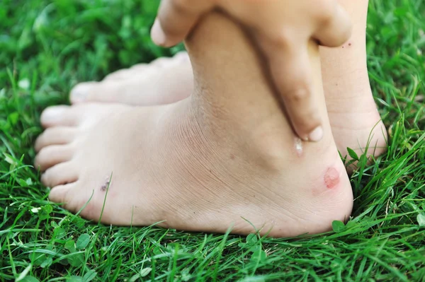 Walking on grass with callus on feet — Stock Photo, Image