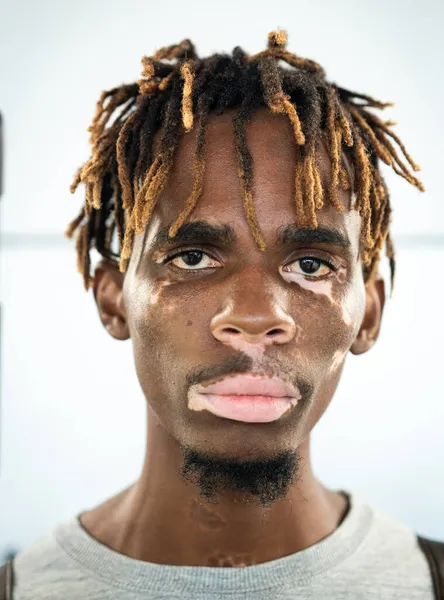 African American black young man with vitiligo skin pigment issue — Stock Photo, Image