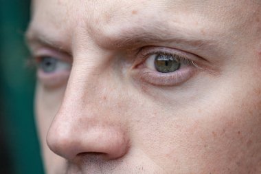 Bir adamda strabismus aynı zamanda bir gözde körlük. Doğuştan görme sorunları. Görme engelli. oftalmoloji kavramı