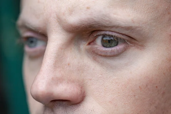 Estrabismo Homem Bem Como Cegueira Olho Problemas Visão Congênita Deficiência — Fotografia de Stock