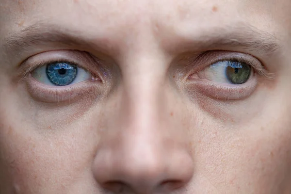 Estrabismo Homem Bem Como Cegueira Olho Problemas Visão Congênita Deficiência Imagens De Bancos De Imagens