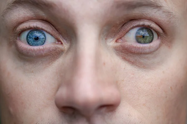 Zez Mężczyzny Ślepota Jednym Oku Wrodzone Zaburzenia Widzenia Upośledzenie Wzroku Zdjęcia Stockowe bez tantiem