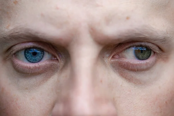 Στραβισμός Έναν Άντρα Καθώς Και Τύφλωση Στο Ένα Μάτι Συγγενή Εικόνα Αρχείου