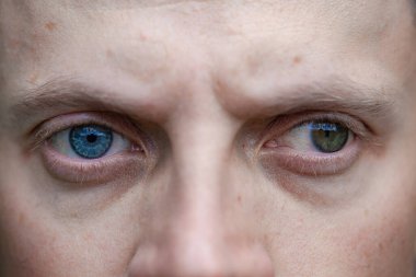 Bir adamda strabismus aynı zamanda bir gözde körlük. Doğuştan görme sorunları. Görme engelli. oftalmoloji kavramı