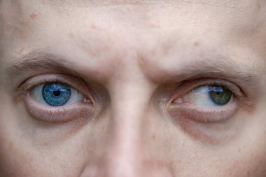 Bir adamda strabismus aynı zamanda bir gözde körlük. Doğuştan görme sorunları. Görme engelli. oftalmoloji kavramı