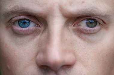 Bir adamda strabismus aynı zamanda bir gözde körlük. Doğuştan görme sorunları. Görme engelli. oftalmoloji kavramı