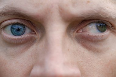 Bir adamda strabismus aynı zamanda bir gözde körlük. Doğuştan görme sorunları. Görme engelli. oftalmoloji kavramı