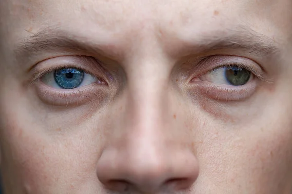 Strabismus Man Well Blindness One Eye Congenital Vision Problems Visual — Stock Photo, Image