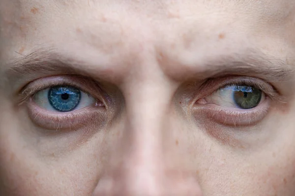 Strabismus Man Well Blindness One Eye Congenital Vision Problems Visual — Stock Photo, Image