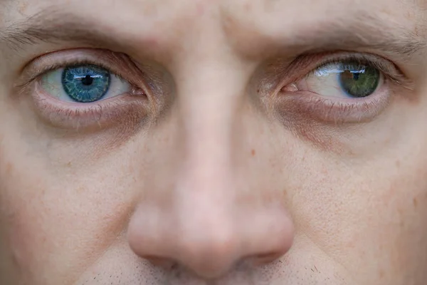 Estrabismo Homem Bem Como Cegueira Olho Problemas Visão Congênita Deficiência — Fotografia de Stock
