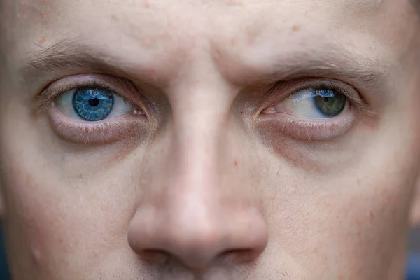 Zez Mężczyzny Ślepota Jednym Oku Wrodzone Zaburzenia Widzenia Upośledzenie Wzroku Obrazy Stockowe bez tantiem