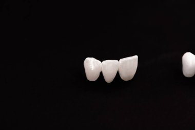 Diş implantı ve taç yerleştirme işleminin parçaları siyah arka planda izole edilmiş. Tıbben doğru 3D model. Merhaba kaliteli fotokopi alanı fotoğrafı. 
