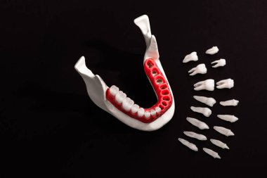 Diş implantı ve taç yerleştirme işleminin parçaları siyah arka planda izole edilmiş. Tıbben doğru 3D model. Merhaba kaliteli fotokopi alanı fotoğrafı. 