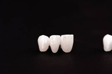 Diş implantı ve taç yerleştirme işleminin parçaları siyah arka planda izole edilmiş. Tıbben doğru 3D model. Merhaba kaliteli fotokopi alanı fotoğrafı. 