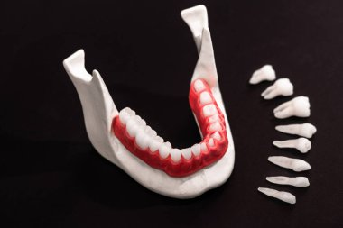 Diş implantı ve taç yerleştirme işleminin parçaları siyah arka planda izole edilmiş. Tıbben doğru 3D model. Merhaba kaliteli fotokopi alanı fotoğrafı. 