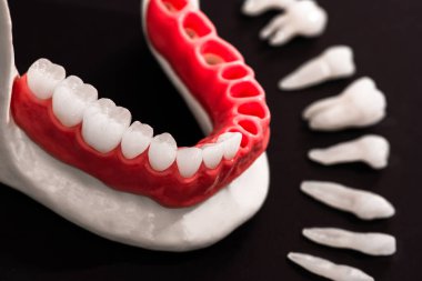 Diş implantı ve taç yerleştirme işleminin parçaları siyah arka planda izole edilmiş. Tıbben doğru 3D model. Merhaba kaliteli fotokopi alanı fotoğrafı. 