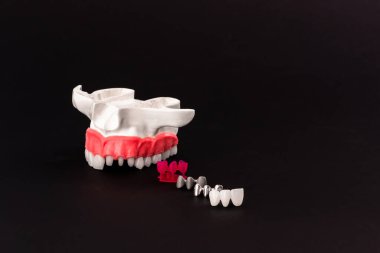 Diş implantı ve taç yerleştirme işleminin parçaları siyah arka planda izole edilmiş. Tıbben doğru 3D model. Merhaba kaliteli fotokopi alanı fotoğrafı. 