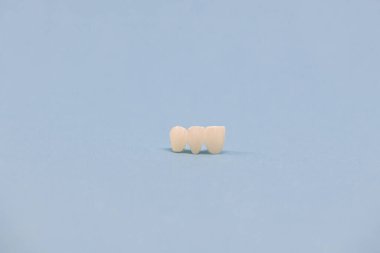 Metalsiz seramik dişler mavi arka planda izole edilmiş diş implantları yerleştirir. Merhaba kaliteli fotokopi alanı fotoğrafı.
