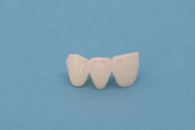 Metalsiz seramik dişler mavi arka planda izole edilmiş diş implantları yerleştirir. Merhaba kaliteli fotokopi alanı fotoğrafı.