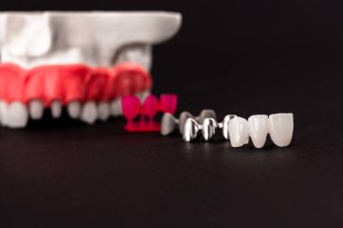 Diş implantı ve taç yerleştirme işleminin parçaları siyah arka planda izole edilmiş. Tıbben doğru 3D model. Merhaba kaliteli fotokopi alanı fotoğrafı. 