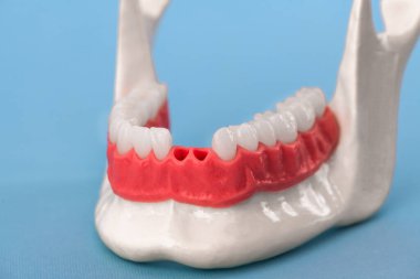 Diş implantı ve taç yerleştirme işlemi parçaları mavi arka planda izole edilmiş. Tıbben doğru 3D model. hI Kalifiye 3D Kopyalama Aralığı Modeli. 