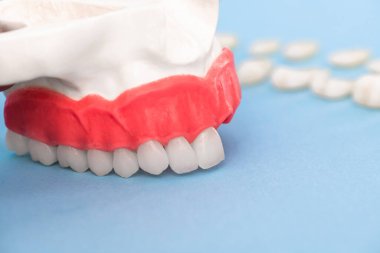 Diş implantı ve taç yerleştirme işlemi parçaları mavi arka planda izole edilmiş. Tıbben doğru 3D model. hI Kalifiye 3D Kopyalama Aralığı Modeli. 