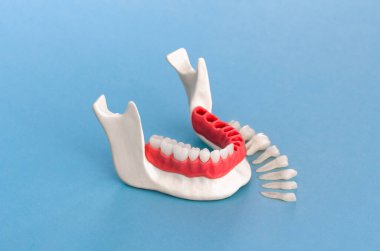 Diş implantı ve taç yerleştirme işlemi parçaları mavi arka planda izole edilmiş. Tıbben doğru 3D model. hI Kalifiye 3D Kopyalama Aralığı Modeli. 