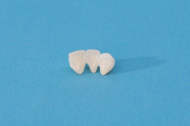 Metalsiz seramik dişler mavi arka planda izole edilmiş diş implantları yerleştirir. Merhaba kaliteli fotokopi alanı fotoğrafı.