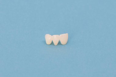 Metalsiz seramik dişler mavi arka planda izole edilmiş diş implantları yerleştirir. Merhaba kaliteli fotokopi alanı fotoğrafı.