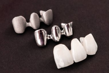 Diş implantı ve taç yerleştirme işleminin parçaları siyah arka planda izole edilmiş. Tıbben doğru 3D model. Merhaba kaliteli fotokopi alanı fotoğrafı. 