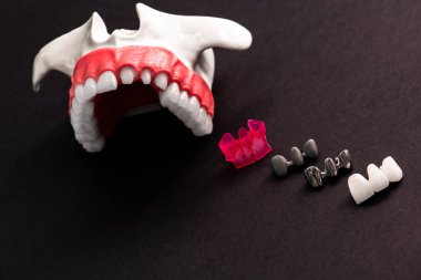Diş implantı ve taç yerleştirme işleminin parçaları siyah arka planda izole edilmiş. Tıbben doğru 3D model. Merhaba kaliteli fotokopi alanı fotoğrafı. 