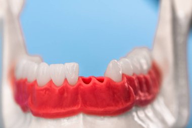 Diş implantı ve taç yerleştirme işlemi parçaları mavi arka planda izole edilmiş. Tıbben doğru 3D model. hI Kalifiye 3D Kopyalama Aralığı Modeli. 