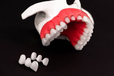 Diş implantı ve taç yerleştirme işleminin parçaları siyah arka planda izole edilmiş. Tıbben doğru 3D model. Merhaba kaliteli fotokopi alanı fotoğrafı. 