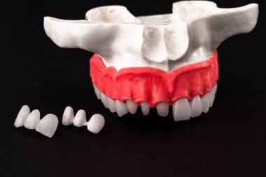 Diş implantı ve taç yerleştirme işleminin parçaları siyah arka planda izole edilmiş. Tıbben doğru 3D model. Merhaba kaliteli fotokopi alanı fotoğrafı. 