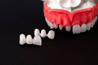 Diş implantı ve taç yerleştirme işleminin parçaları siyah arka planda izole edilmiş. Tıbben doğru 3D model. Merhaba kaliteli fotokopi alanı fotoğrafı. 