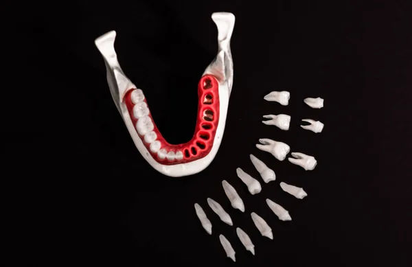 Piezas Del Proceso Instalación Del Implante Dental Corona Aisladas Sobre —  Fotos de Stock