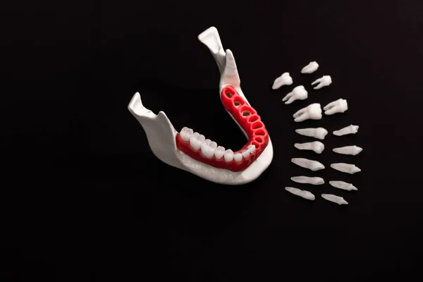 Teeth Implant Crown Installation Process Parts Isolated Black Background Medically — Stock Photo, Image