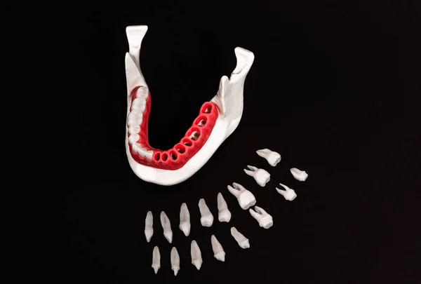 歯のインプラントとクラウンの設置プロセス部品は黒い背景に隔離されています 医学的に正確な3Dモデル 高品質のコピースペースの写真 — ストック写真