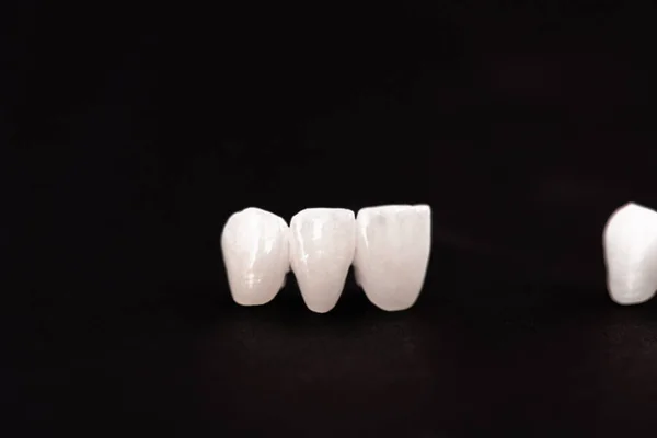 Diş Implantı Taç Yerleştirme Işleminin Parçaları Siyah Arka Planda Izole — Stok fotoğraf