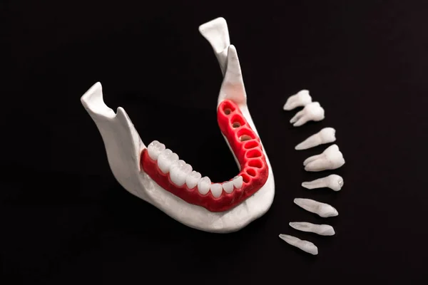 Teeth Implant Crown Installation Process Parts Isolated Black Background Medically — Stock Photo, Image