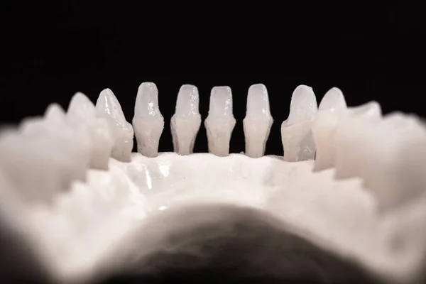 歯の解剖学的モデルを持つ低人間の顎は黒の背景に隔離された 健康な歯 歯のケア 歯列矯正医療の概念 コピースペース付き高品質の写真 — ストック写真