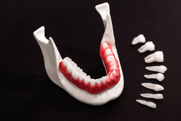 Teeth Implant Crown Installation Process Parts Isolated Black Background Medically — Stock Photo, Image